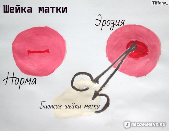 Эрозия. Прижигание шейки матки. фото