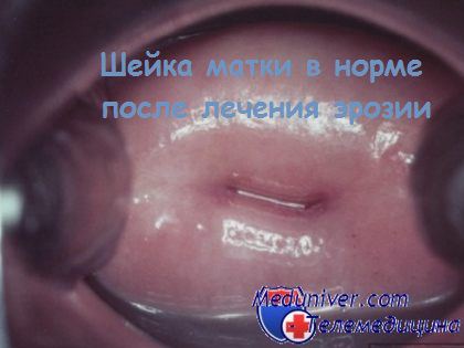 лечение эрозий шейки матки