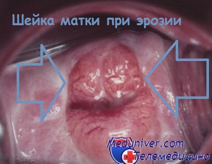 лечение эрозий шейки матки