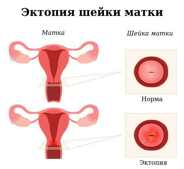Шейка матки: норма и эктопия