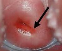 Эктропион шейки матки