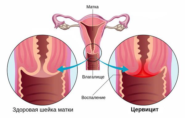 Воспаление цервикального канала шейки матки
