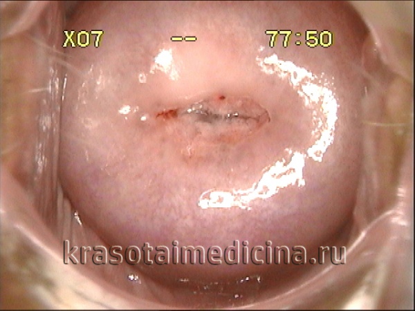 Кольпоскопия. Небольшая эктопия призматического эпителия, подозрение на эндоцервицит