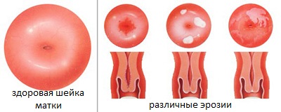 виды эрозии шейки матки