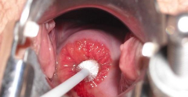 Хроническая эрозия шейки матки