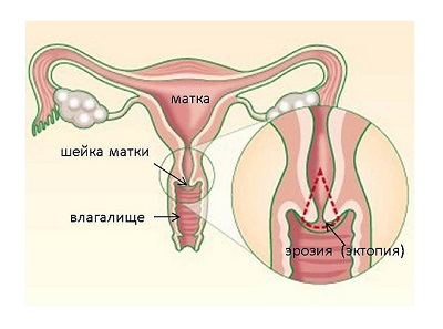 эрозия шейки матки