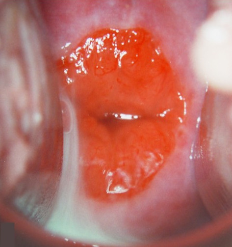 Выраженная эрозия шейки матки фото с кольпоскопии 
