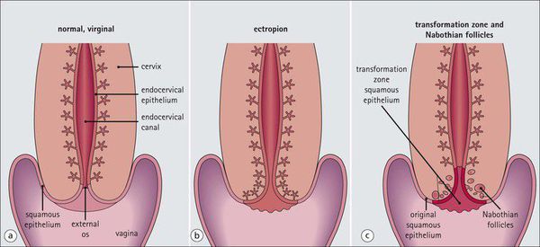 Патогенез эрозии шейки матки