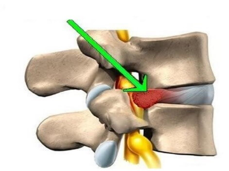 Лечение боли в пояснице в Киеве