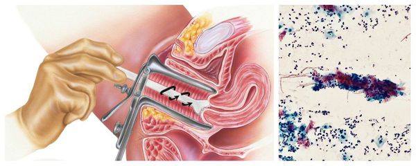 Взятие мазка из цервикального канала: признаки кандидозного цервицита