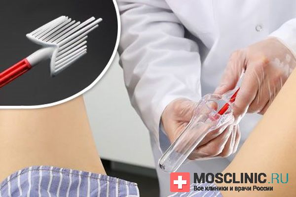 жидкостная цитология шейки матки