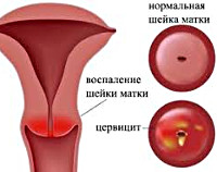 Хронический цервицит