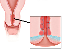 Эндоцервицит