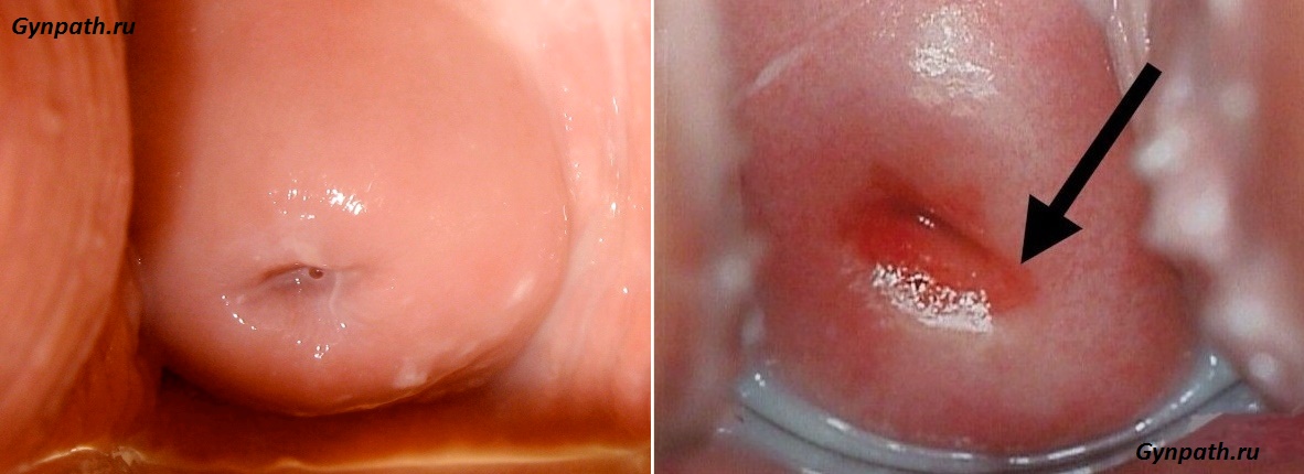 эрозия шейки матки фото при кольпоскопии
