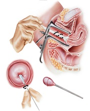 Взятие цитологического анализа
