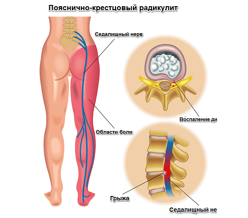 Лечение боли в пояснице в Киеве