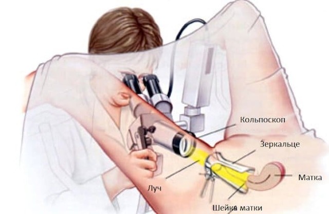 Анализы при эрозии шейки матки