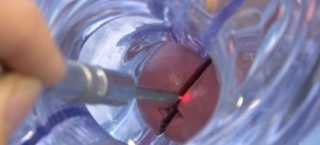 Анализы при эрозии шейки матки