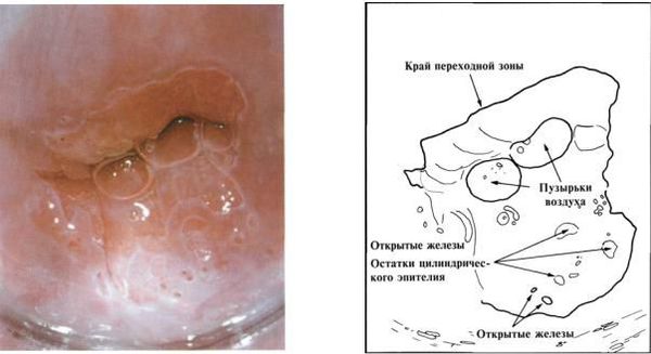 Открытые крипты под многослойным плоским эпителием