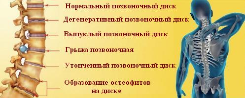 Боли в поясничной области