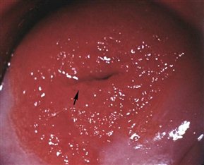 Эрозия шейки матки, диагностика и лечение в Краснодаре