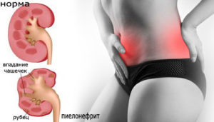 Левофлоксацин - аналоги и заменители последнего поколения