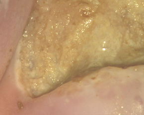 сразу после коагуляции