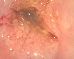 диагностическая проба с уксусной кислотой