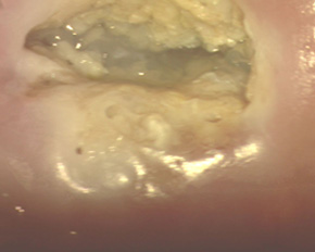 сразу после прижигания аргоном