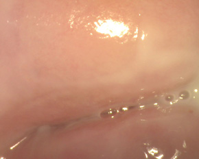 после лечения