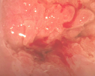 сосочковая эрозия