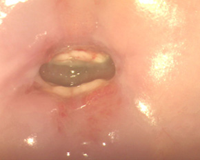 через 1 месяц после прижигания аргоном