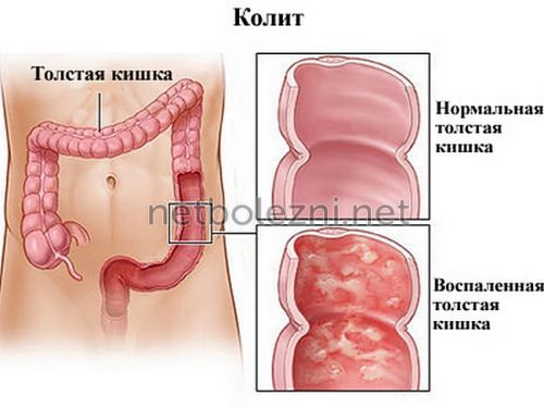 Воспаление прямой кишки