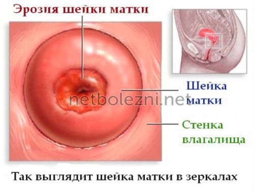 Эрозия шейки матки