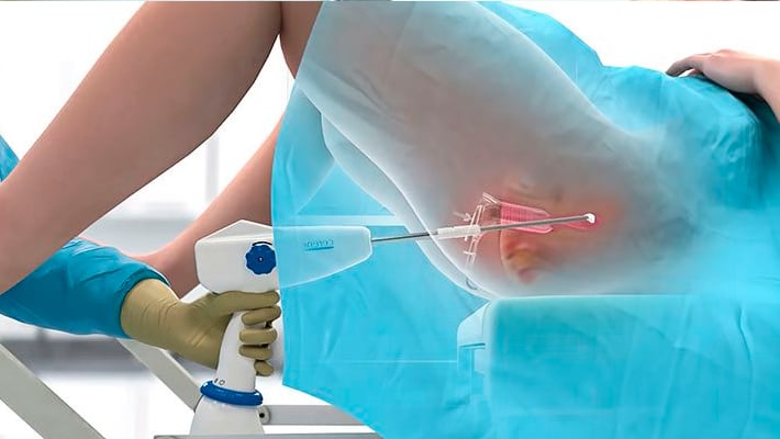 Лечение эрозии шейки матки