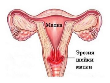 eroziya_sheiki_matki1
