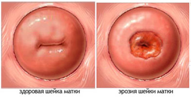 Нормальная шейка матки и с эрозией