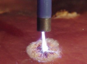 лечение эрозии шейки матки уфа