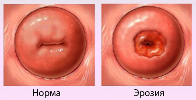 Норма и эрозия