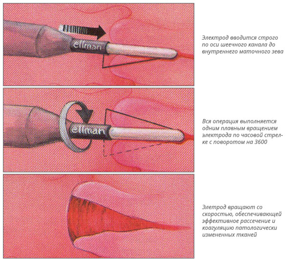 эрозия шейки матки