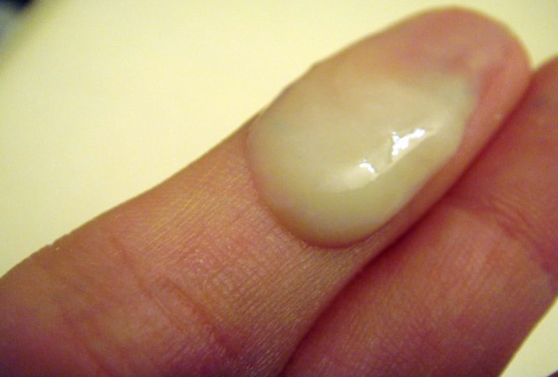 гнойные выделения