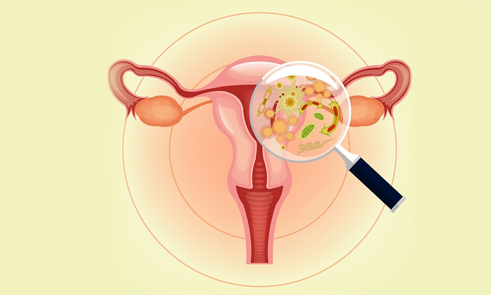 инфекции влагалища