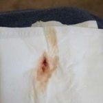 Коричневые выделения со сгустками