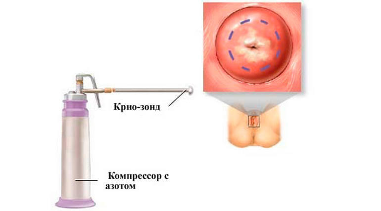 Как прижигают эрозию шейки матки: методики, преимущества, недостатки