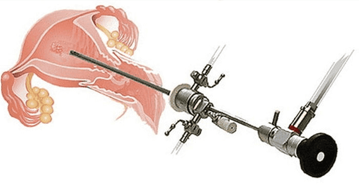 Диагностическое выскабливание полости матки