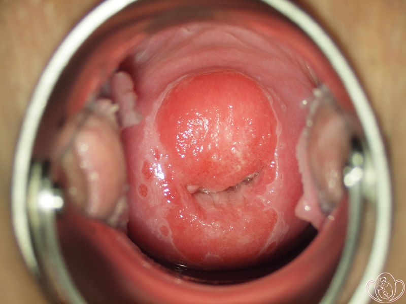 железистая псевдоэрозия шейки фото