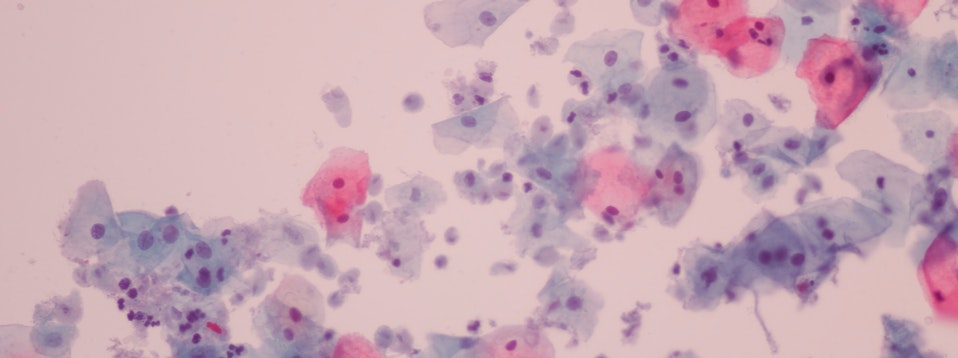 Вагинальная инфекция